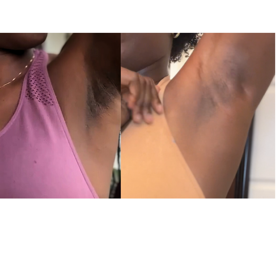 Brighter, Smoother Underarms in Just 6 Weeks – Real Results with Turmeric Soap